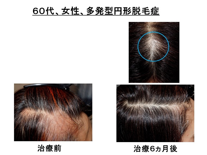 円形脱毛症　病院